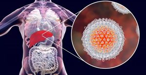 hepatitis